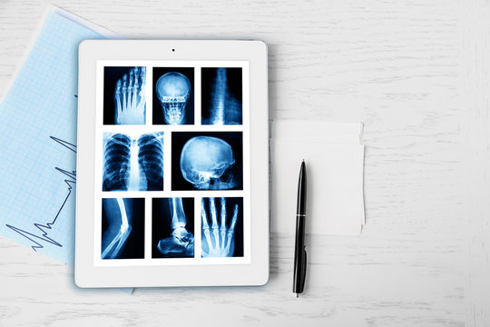 X-rays on the tablet screen on wooden table