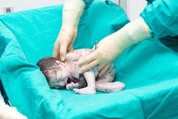 Real operation for cesarean section with new born infant in operating theater.