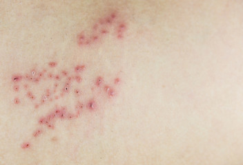 Raised red bumps and blisters on skin