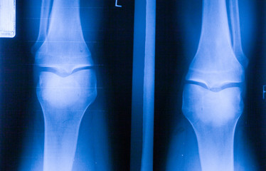 Ankle feet & knee joint X-ray human photo film