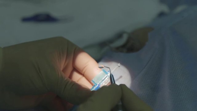 Folding IOL before implantation during cataract extraction operation