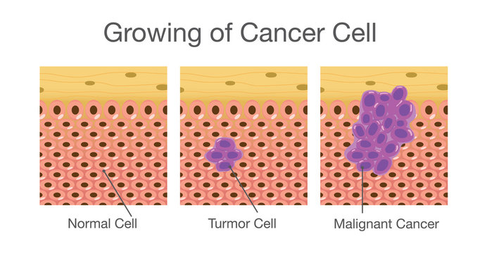 Growing and invasive of cancer cell in human. Medical illustration.