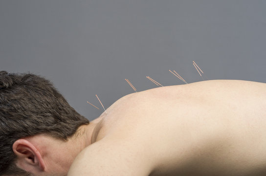 Chinese Medicine Doing Acupuncture To Man Patient