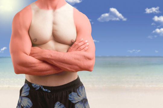 Fit Man Standing In A Beach With A Sunburn