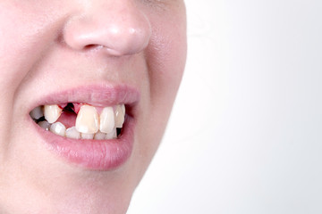 Naklejka premium Female without tooth 