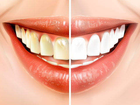 comparison of teeth