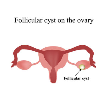 Follicular ovarian cyst. Functional cyst. Infographics. Vector illustration on isolated background