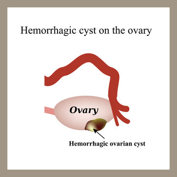 Hemorrhagic cyst on the ovary. Ovary. Infographics. Vector illustration on isolated background