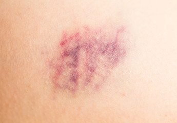 Fototapeta premium Bruise on human leg