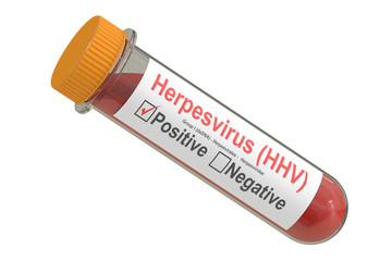 Test tube with blood sample positive with herpesvirus hhv virus,