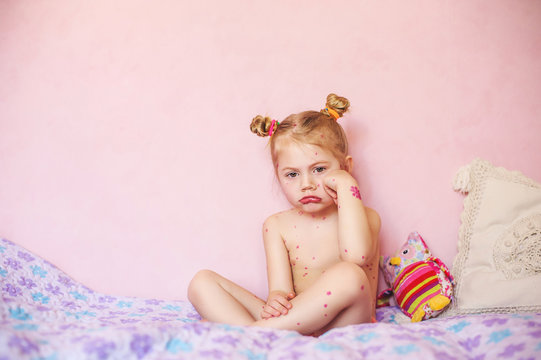 baby sitting on bed with chicken pox rash, natural photo