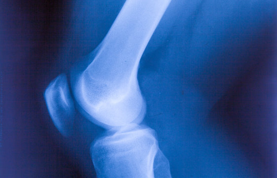 Ankle feet & knee joint X-ray human photo film