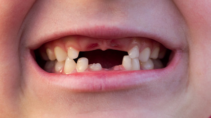 Mouth of child with Changing Teeth