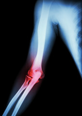 Arthritis at elbow .  film x-ray of arm , elbow , forearm and inflammation at elbow ( Gouty arthritis , Rheumatoid arthritis )  ( black background )