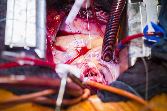 Heart valve operation