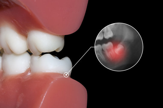 dental infographic wisdom tooth information