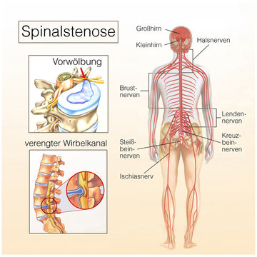 Spinalstenose.Vorw&ouml;lbung.Verengter Wirbelkanal