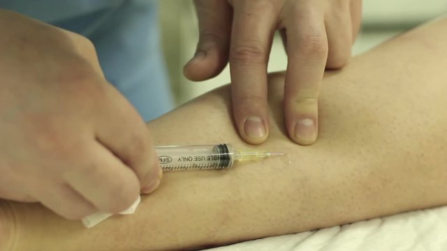 Sclerotherapy. Treatment Of Varicose Veins