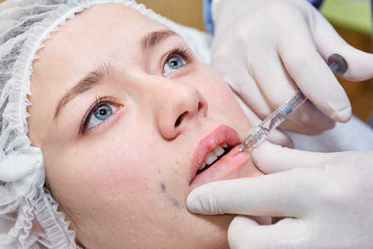 Procedure of lip injection.
