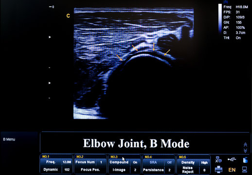 Colourful ultrasound monitor image. Elbow Joint, B Mode