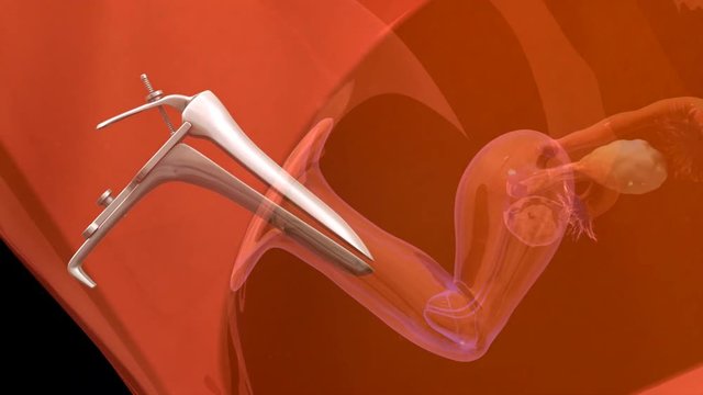 In vitro fertilization.