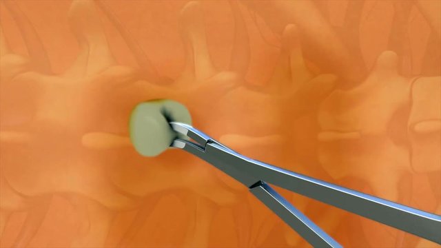 Spinal & Epidural anaesthesia
