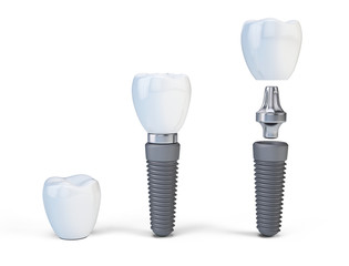 Tooth human implant isolated on white. 3d render - obrazy, fototapety, plakaty