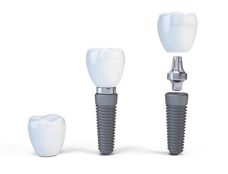 Tooth human implant isolated on white. 3d render