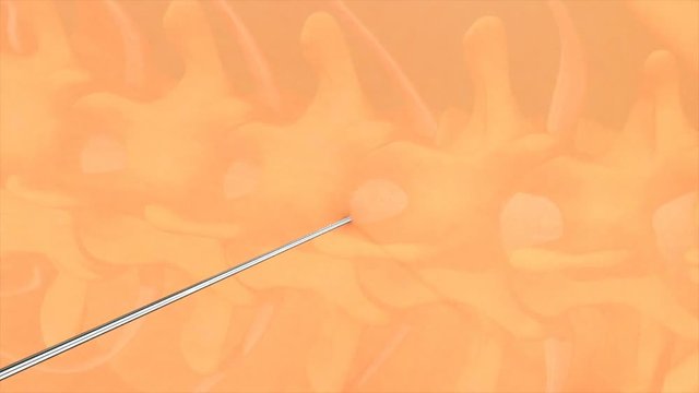 Spinal & Epidural anaesthesia