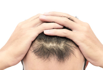 Fototapeta premium Young man serious hair loss problem for hair loss concept