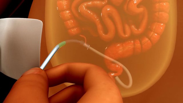 Peritoneal dialysis