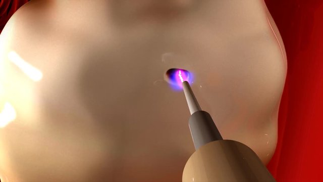 Laparoscopic ovarian drilling