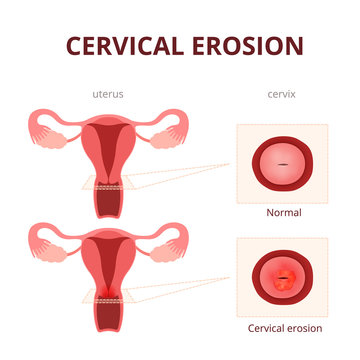 cervical erosion schematic illustration