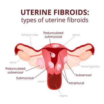 uterine fibroids schematic illustration