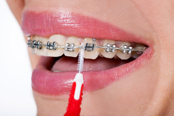 beautiful teeth with perfect oral hygiene,close up