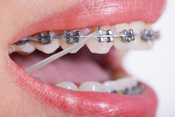 Closeup Ceramic and Metal Braces on Teeth with Elastic Rubber Ba