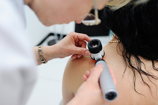 melanoma diagnosis. the doctor examines the patient's mole
