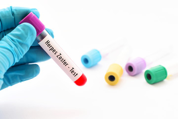 Fototapeta premium Blood sample for herpes zoster test