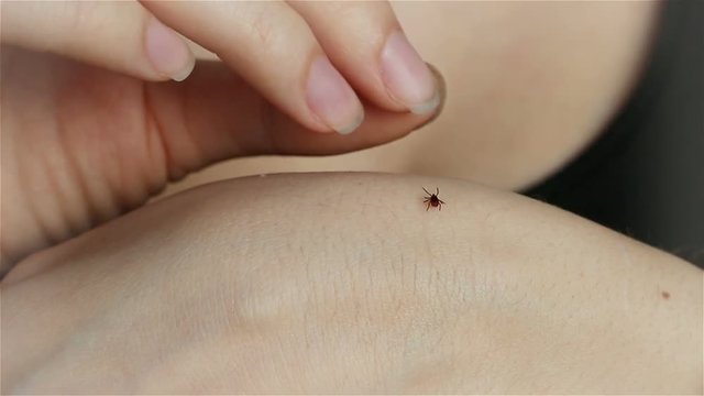 Wood Tick Crawling on human Skin. Parasites, Tick-borne Encephalitis.