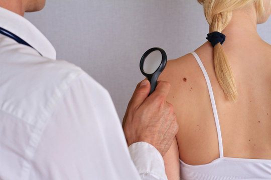 Dermatologist examines a birthmark of patient. Checking benign moles. Skin tags removal.