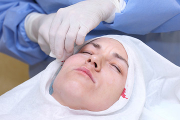 Fototapeta na wymiar Procedure of face lifting surgery.