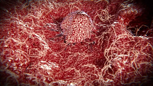 Wandernde  Krebszelle. 
Wandernde Krebszellen können zu Metastasen führen.