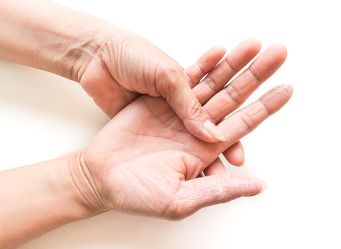 Woman's hand atopic dermatitis symptom skin texture on white background