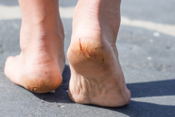 Macro photo of cracked heels. Male back view.