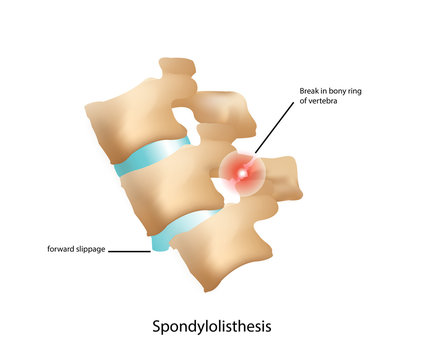 Spondylolisthesis condition in which one vertebra slides forward over the bone below