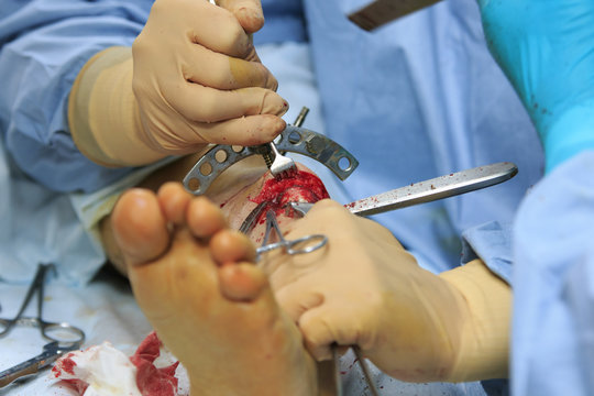 Orthopedic surgery close-up with different surgical tools and instruments