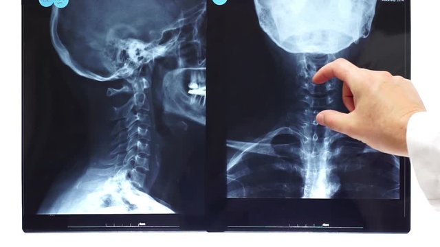 An anonymous doctor or nurse or health care specialist points to an x-ray of the cranium and neck of a patient.