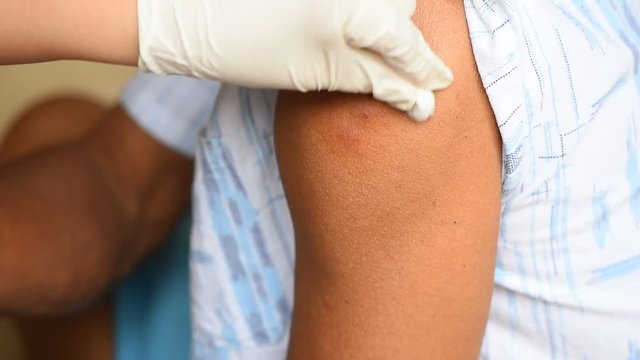 intradermal injection technique
