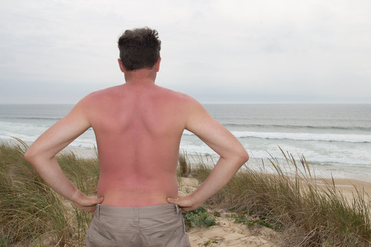 Sunburned Male Back Red Back At The Beach