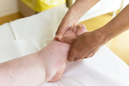 Terapista che esegue il massaggio linfodrenante  manuale su gambe con problemi di edema linfatico
